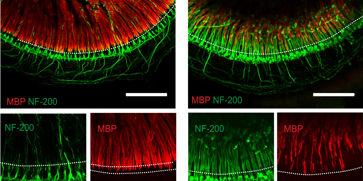 Dargestellt sind Kulturen des Sinnesepithels des Innenohres immunhistochemisch gefärbt mit Antikörpern gegen myelin basic protein (MBP, rot; Myelinisierung) und gegen NF-200 (grün) als Marker für alle Nervenfasern. In BACE1 knock-out Mäusen ist die Myelinisierung (rot) drastisch reduziert und die Nervenfasern sind dicker und am (synaptischen Ende) desorganisiert und geschwollen. Deswegen kommt es bei diesen Mäusen zu einem signifikanten Hörverlust. Foto: Marlen Dierich. Faerbungen_Innenohr.jpg