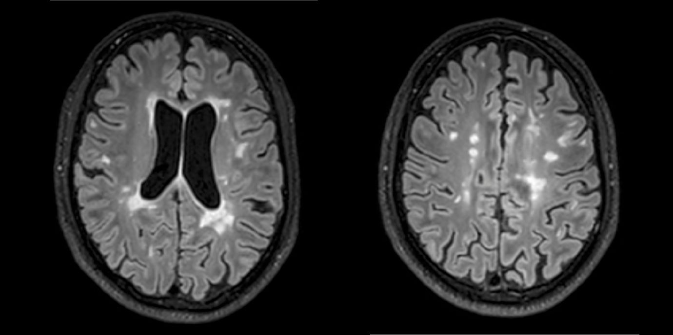 Die Aufnahmen aus der Magnetresonanztomographie zeigen einen jungen Patienten mit Multipler Sklerose mit mehreren entzündlichen Läsionen des Gehirns. ©Radiologie Innsbruck NEWS_MRT_MS_Hegen.jpg