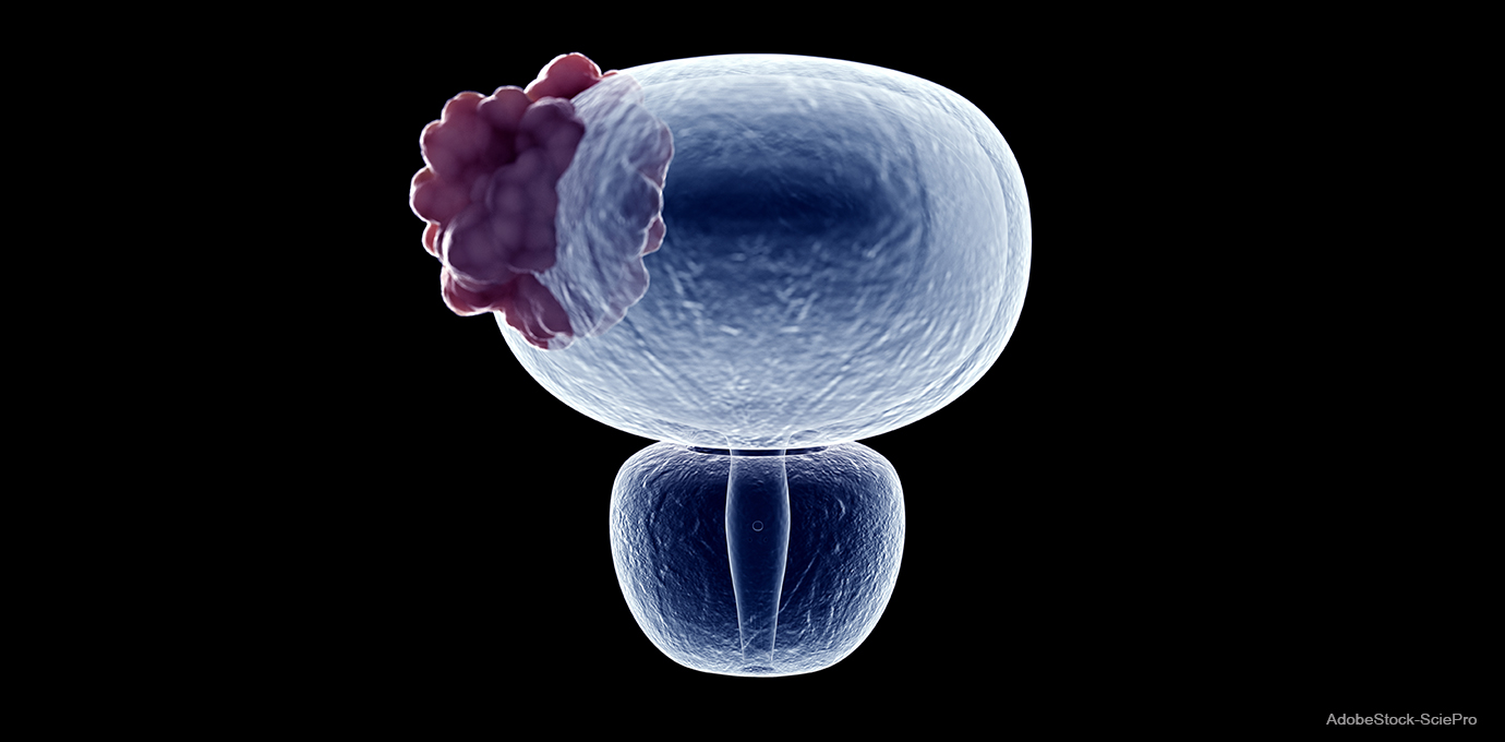 Blasenkarzinom: der unterschätzte Krebs