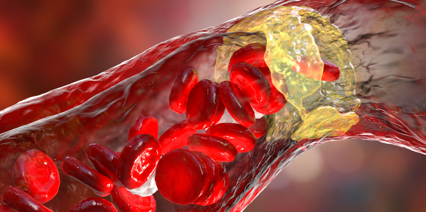 Familiäre Hypercholesterinämie bei Kindern und Jugendlichen: hohe Prävalenz – niedrige Diagnoserate