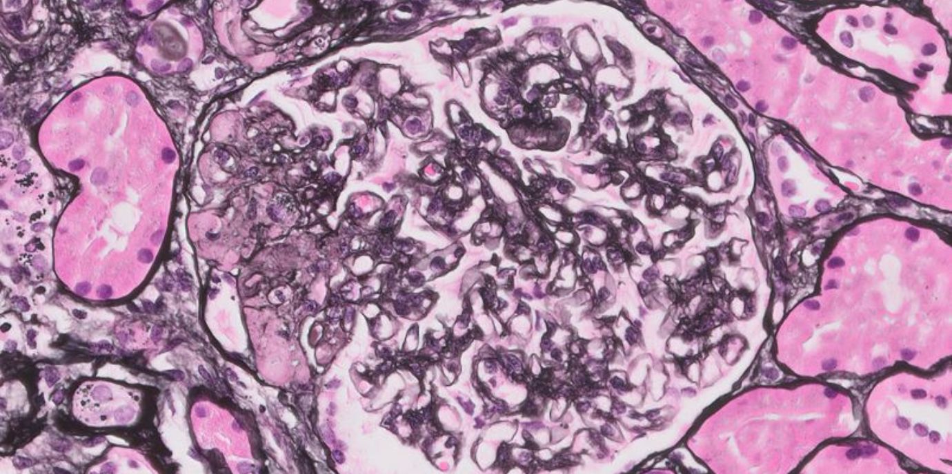 Rituximab-Studie bei nephrotischem Syndrom stimmt optimistisch