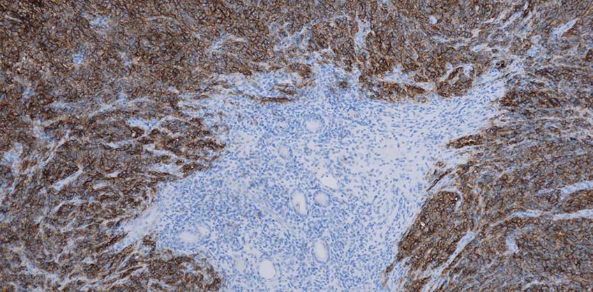 Neuer Biomarker für das Nasen-Rachen-Karzinom