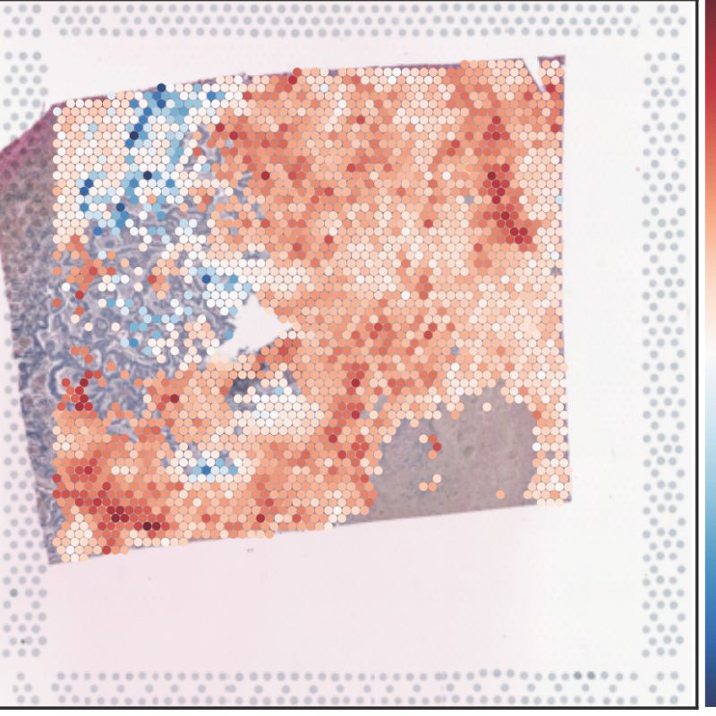 Das hochauflösende Spatial Transcriptomics Bild zeigt die Anhäufung von sauerstoffarmen Regionen am Tumorrand, die vorwiegend von langlebigen SPP1+ myeloiden Zellen (blau) besetzt sind und während der Leberdurchblutung zurückgehalten werden. ©Manuel Trebo
