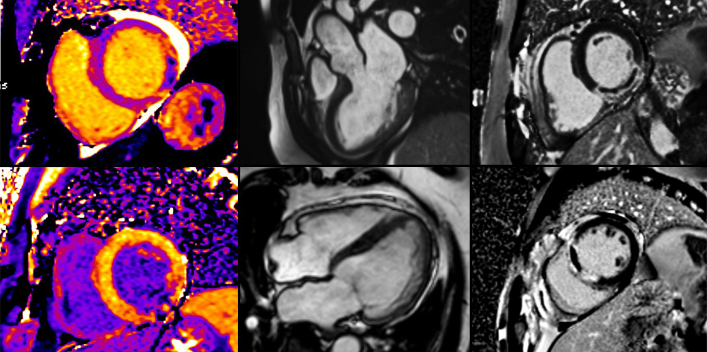 Lockdown bedingte schwerere Herzinfarkte