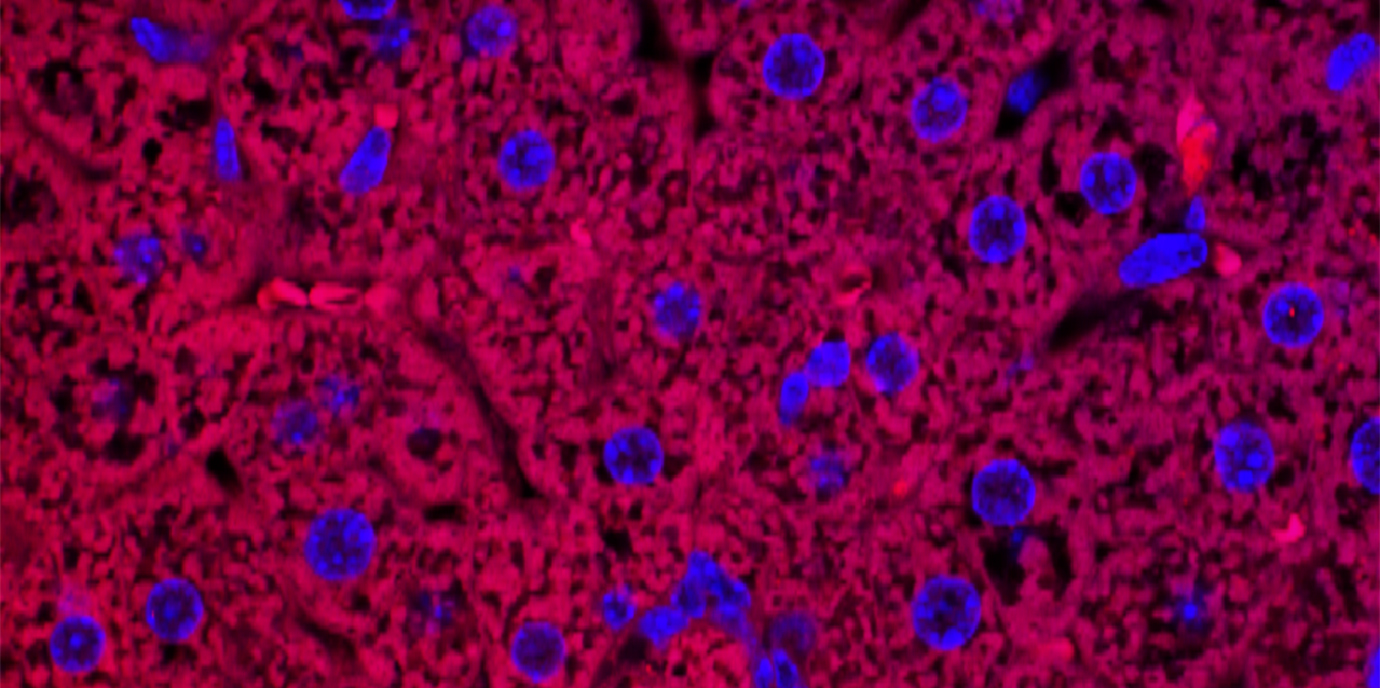 Therapielichtblick für die alkoholbedingte Lebererkrankung