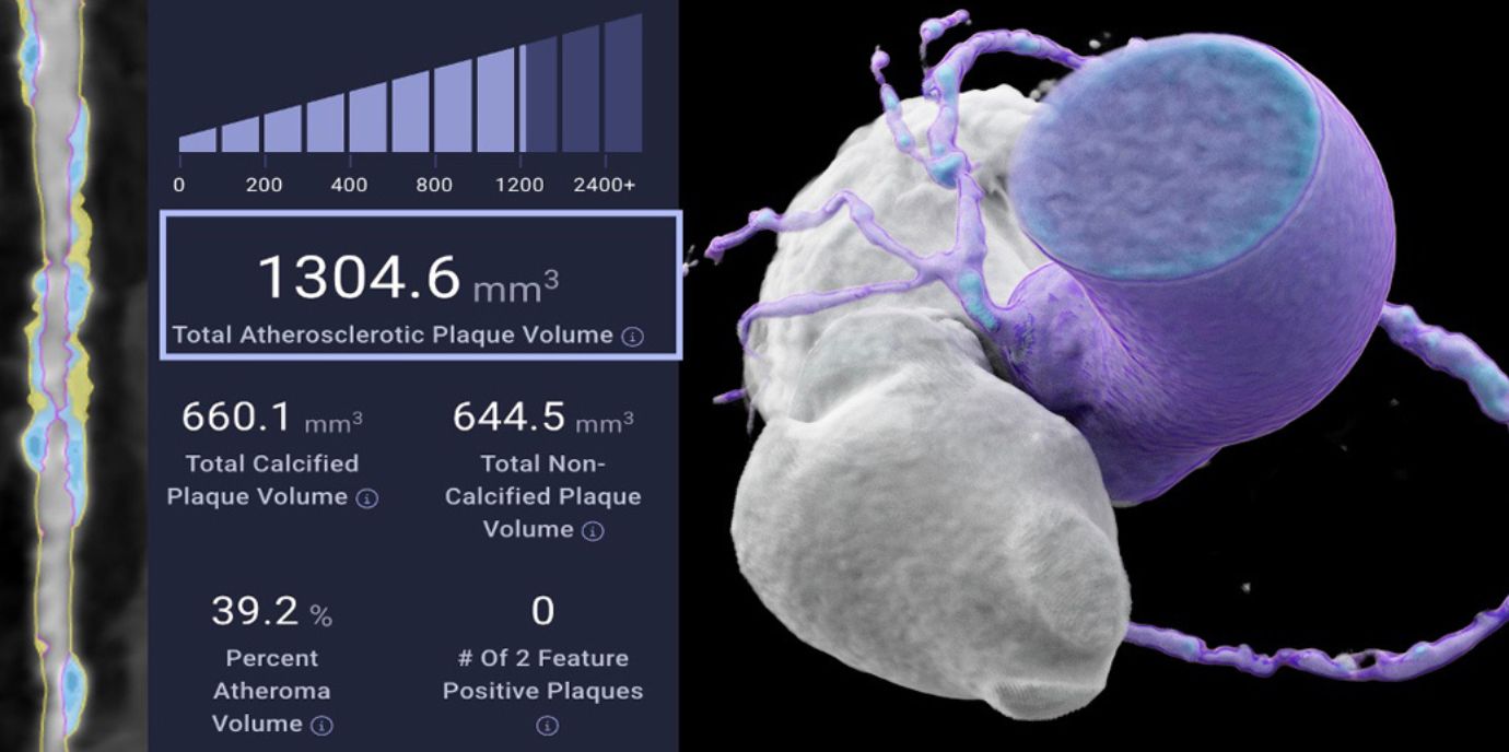 AI-gestützte Koronar-CT-Bildgebung zeigt geschlechtsspezifische Unterschiede bei Plaqueprofil und kardiovaskulärem Risiko