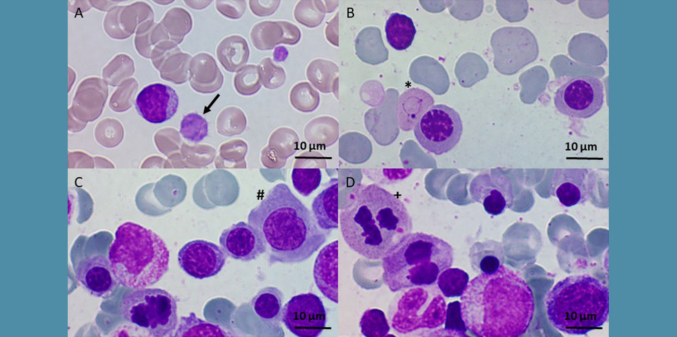 Seltene Mutation führte zu pränataler Blutarmut