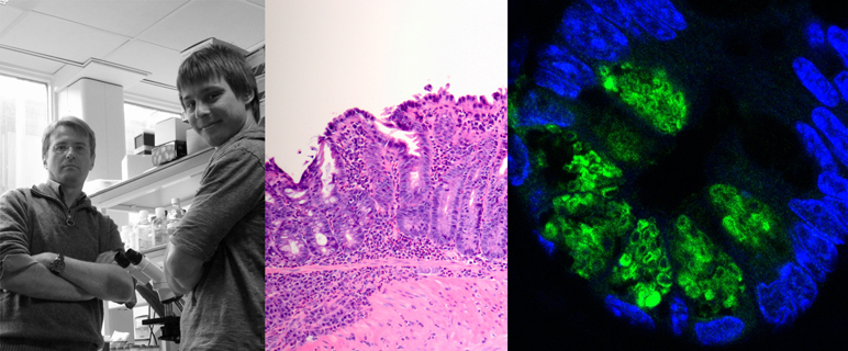 Morbus Crohn: Identifikation krankheitsrelevanter Zellen eröffnet neue Therapiezugänge