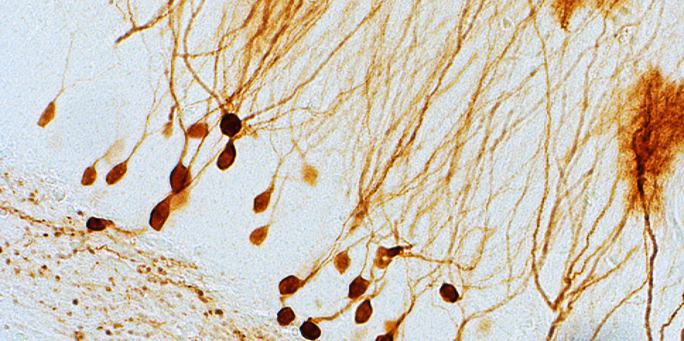 Neue Gentherapie zur Behandlung von Epilepsie