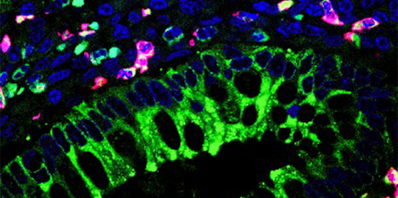 Neue Biomarker für die gezielte Therapie chronisch-entzündlicher Darmerkrankungen