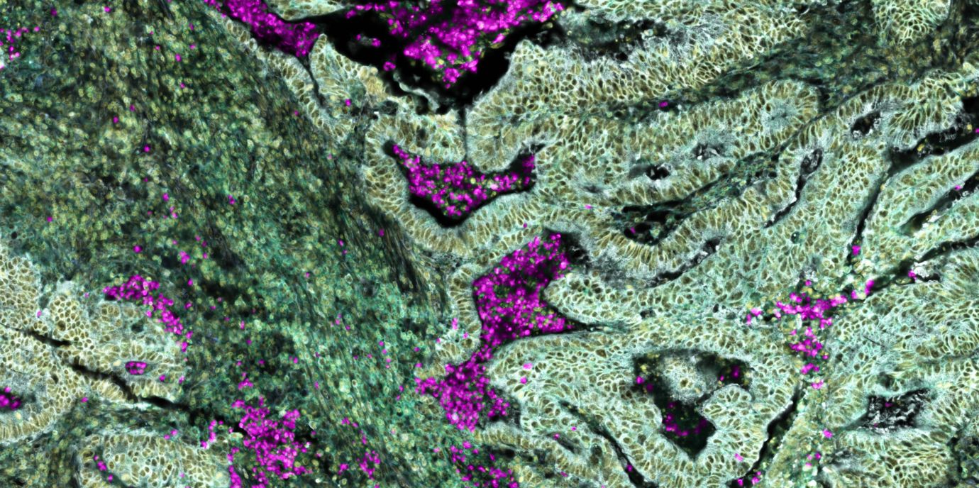 Darmkrebs programmiert Immunzellen bereits im Knochenmark um