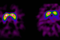 Welt-Parkinson-Tag am 11. April: Frühe Diagnose kann Krankheitsverlauf verzögern